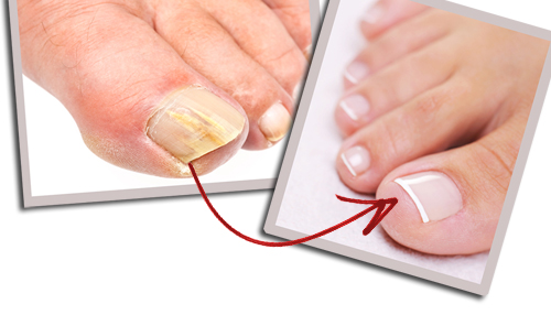 Why toenail infections happens and how you can do the treatment?