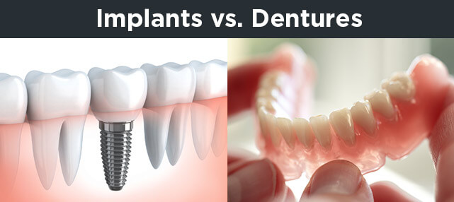 Dental implants Vs dentures: which is a better teeth replacement solution?