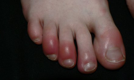 How To Get Rid Of Bunion