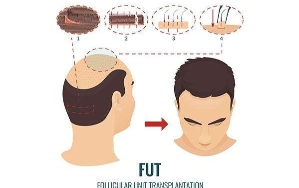 Is Hair Transplant Successful? A True Story