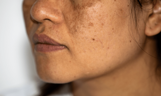 Hyperpigmentation: What is It and How Can I Get Rid of It?