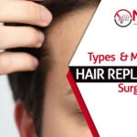 What is hair replacement surgery? What are the types and procedures of it?