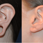 Effective and Professional Earlobe Repair in New York